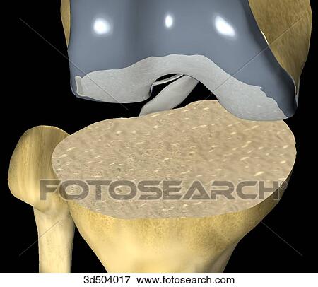 Anterior and slightly superior view of a flexed knee showing the articular surface of the tibia after resection during knee arthroplasty surgery. Artificial proximal joint already in place. View Large Illustration Stock Illustration - Anterior and slightly superior view of a flexed knee showing the articular surface of the tibia after resection during knee arthroplasty surgery. Artificial proximal joint already in place.. Fotosearch