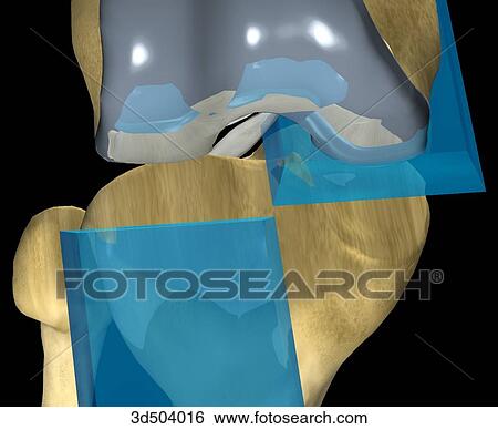 Stock Illustration - Anterior view from above of a flexed knee with an artificial proximal joint in place. Planes of resection of the articular tibial surface during knee arthroplasty surgery are indicated by the blue structures.. Fotosearch