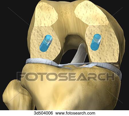 Anterior view of flexed knee showing partially resected distal femur with location of drill holes indicated in blue during knee arthroplasty. View Large Illustration Stock Illustration - Anterior view of flexed knee showing partially resected distal femur with location of drill holes indicated in blue during knee arthroplasty.. Fotosearch