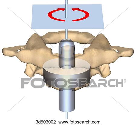 Drawing - Axis and atlas superimposed of a schematic representation of an atlantoaxial joint.. Fotosearch