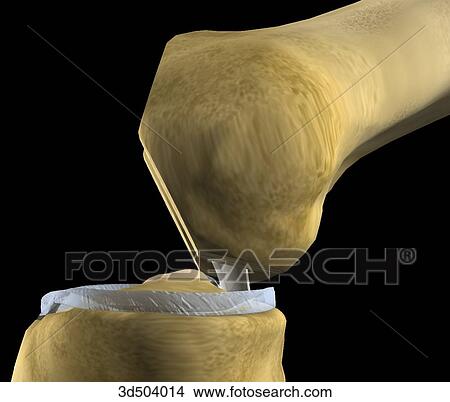 Lateral view of flexed knee after condyles have been resected in preparation for artificial knee during knee arthroplasty surgery. View Large Illustration Stock Illustration - Lateral view of flexed knee after condyles have been resected in preparation for artificial knee during knee arthroplasty surgery.. Fotosearch