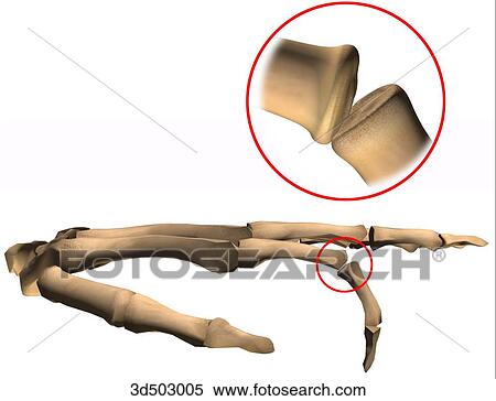 Stock Illustration - Medial view of the bones of the hand highlighting the metacarpal and proximal phalanx junction, an example of a condyloid joint.. Fotosearch