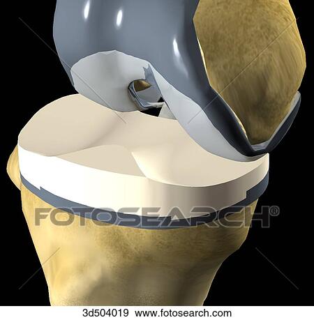 Oblique view of a knee with a total knee replacement following knee arthroplasty surgery. View Large Illustration Stock Illustration - Oblique view of a knee with a total knee replacement following knee arthroplasty surgery.. Fotosearch