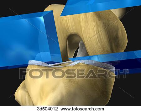 Drawing - Three symbolic blades illustrate the planes of resection in the distal end of the femur during knee arthroplasty surgery.. Fotosearch