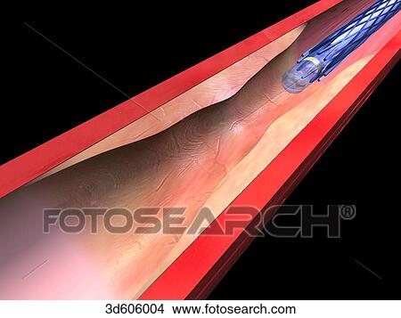 Stock Illustration - Balloon catheter carrying stent is approaching narrowed area of artery.. Fotosearch