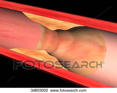 Cross-sectional view of a coronary artery with atherosclerotic plaque buildup. View Large Illustration Drawing - Cross-sectional view of a coronary artery with atherosclerotic plaque buildup.. Fotosearch