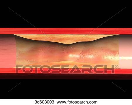 Cross-sectional view of a coronary artery with atherosclerotic plaque buildup. View Large Illustration Drawing - Cross-sectional view of a coronary artery with atherosclerotic plaque buildup.. Fotosearch