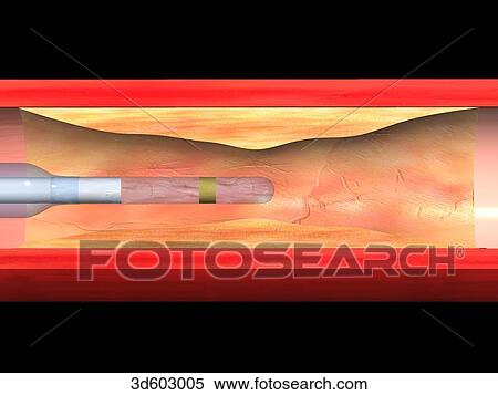 Stock Illustration - Cross-sectional view of a coronary artery with atherosclerotic plaque build-up. An unexpanded balloon catheter is being introduced into this area.. Fotosearch