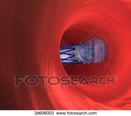 Drawing - Deflated balloon catheter and vascular stent is being led through artery.. Fotosearch