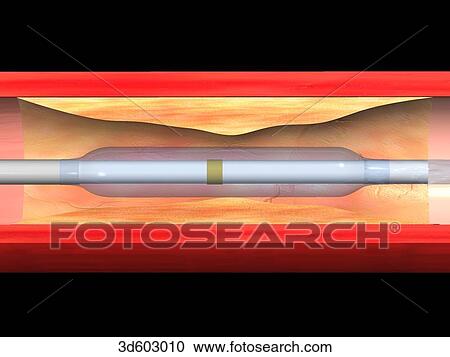 Clipart - Longitudinal section of atherosclerotic artery with balloon catheter in place prior to inflation.. Fotosearch