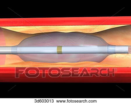 Longitudinal section of atherosclerotic artery with balloon catheter having been inflated. Inflated balloon increases diameter of lumen. View Large Illustration Drawing - Longitudinal section of atherosclerotic artery with balloon catheter having been inflated. Inflated balloon increases diameter of lumen.. Fotosearch