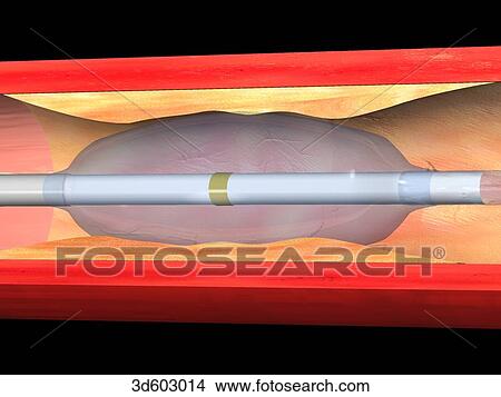 Stock Illustration - Longitudinal section of atherosclerotic artery with balloon catheter having beenfurther inflated. Inflated balloon increases diameter of lumen.. Fotosearch