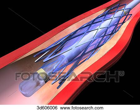 Stock Illustration - Vascular stent has been fully extended through the inflation of the balloon catheter. Lumen of artery has thus been widened.. Fotosearch