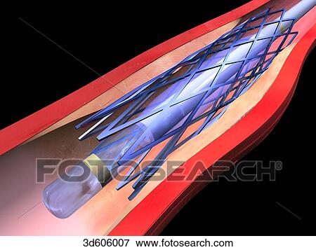 Stock Illustration - Vascular stent has been fully extended and the balloon catheter has begun to be deflated prior to removal. Expanded stent keeps artery lumen open.. Fotosearch
