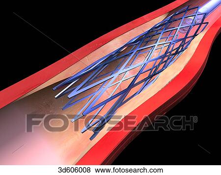 Vascular stent has been fully extended and the balloon catheter is being removed. Expanded stent keeps artery lumen open. View Large Illustration Stock Illustration - Vascular stent has been fully extended and the balloon catheter is being removed. Expanded stent keeps artery lumen open.. Fotosearch
