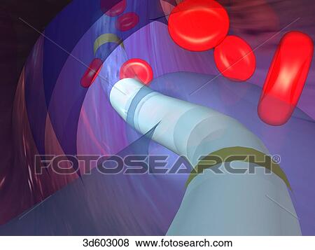 View from inside a cannula that has been passed through a coronary artery. A balloon catheter is being passed through the catheter. Erythrocytes can be seen. View Large Illustration Stock Illustration - View from inside a cannula that has been passed through a coronary artery. A balloon catheter is being passed through the catheter. Erythrocytes can be seen.. Fotosearch