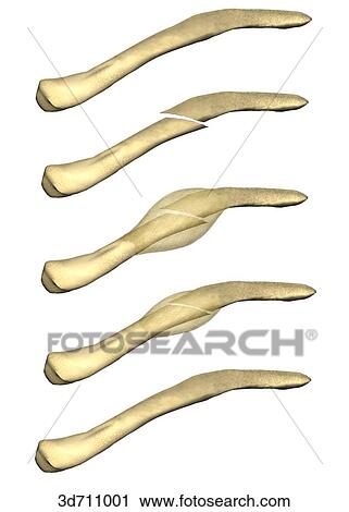 A part of the bone fracture healing process. View Large Illustration Clip Art - A part of the bone fracture healing process.. Fotosearch