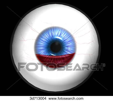 Stock Illustration - Anterior chamber and subconjunctival hemorrhages.. Fotosearch