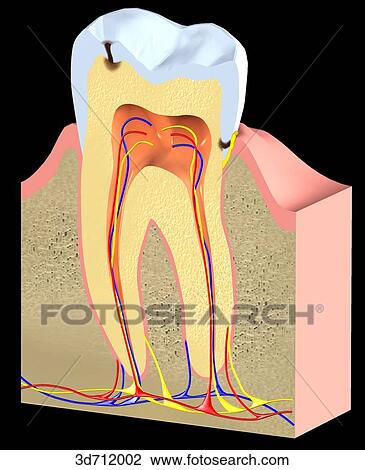 Drawing - Caries. Acid, enzymes, or both produced by oral bacteria have broken down enamel to form cavities.. Fotosearch