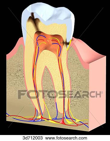 Caries. Bacteria penetrated dentin to invade the pulp cavity. View Large Illustration Drawing - Caries. Bacteria penetrated dentin to invade the pulp cavity.. Fotosearch