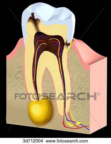 Stock Illustration - Caries. Infection destroys pulp and extends through left root canal to cause periapical disease.. Fotosearch