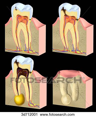 Caries is the localized, progressively destructive disease of the teeth. View Large Illustration Clip Art - Caries is the localized, progressively destructive disease of the teeth.. Fotosearch