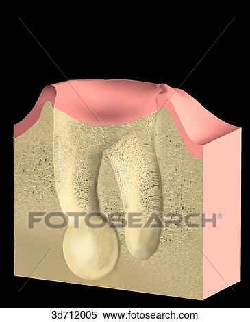Caries. The tooth has been lost, leaving periapical cyst on the left. View Large Illustration Stock Illustration - Caries. The tooth has been lost, leaving periapical cyst on the left.. Fotosearch