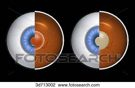 Cataract versus normal lens. View Large Illustration Drawing - Cataract versus normal lens.. Fotosearch