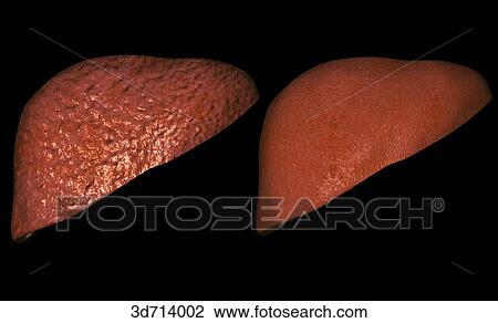 Cirrhosis versus normal liver. View Large Illustration Drawing - Cirrhosis versus normal liver.. Fotosearch