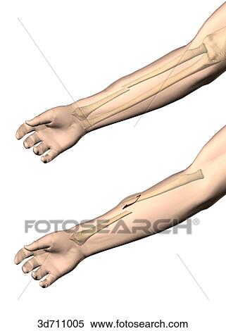 Stock Illustration - Closed versus open fractures.. Fotosearch