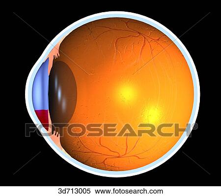 Stock Illustration - Cross-section of eye showing anterior chamber and subconjunctival hemorrhages.. Fotosearch
