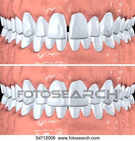 Diastema (space) between teeth closed by resin composite veneers. View Large Illustration Stock Illustration - Diastema (space) between teeth closed by resin composite veneers.. Fotosearch