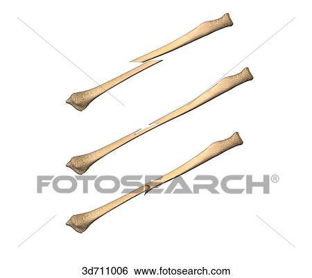 Displaced, greenstick, and impacted fractures. View Large Illustration Stock Illustration - Displaced, greenstick, and impacted fractures.. Fotosearch