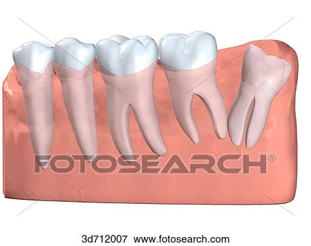 Distoangular impacted third molar. View Large Illustration Stock Illustration - Distoangular impacted third molar.. Fotosearch