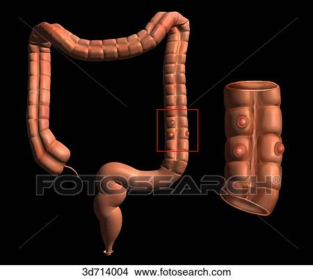 Stock Illustration - Diverticulosis seen in a segment of the descending colon.. Fotosearch