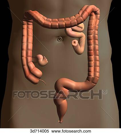 Stock Illustration - Establishment of a fistula through which the ileum discharges directly to the outside of the body.. Fotosearch