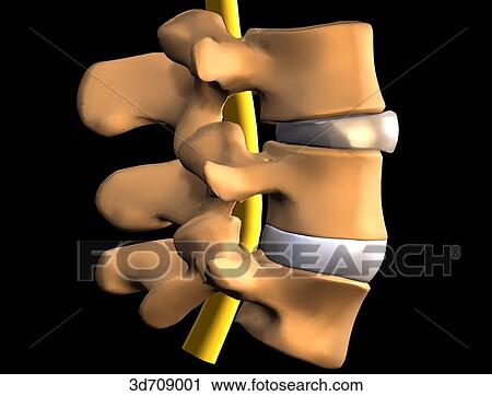 Clip Art - Intervertebral disk, anterior herniation.. Fotosearch