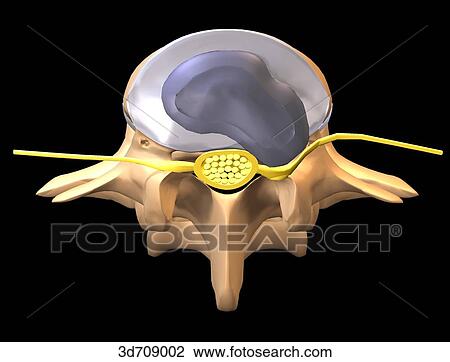 Drawing - Intervertebral disk, lateral herniation.. Fotosearch
