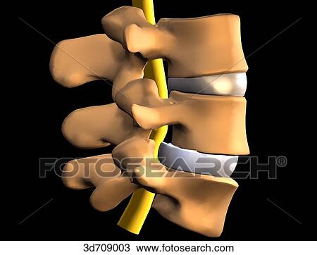 Drawing - Intervertebral disk, posterior herniation.. Fotosearch