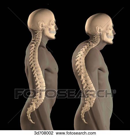 Kyphosis (right) vs. lordosis (left). View Large Illustration Drawing - Kyphosis (right) vs. lordosis (left).. Fotosearch