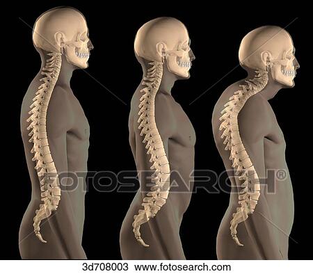 Drawing - Kyphosis (right) vs. lordosis (middle) vs. normal (left).. Fotosearch