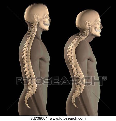 Stock Illustration - Kyphosis (right) vs. normal spinal column (left).. Fotosearch