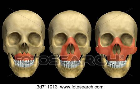 Le Fort I, II, and III fractures. View Large Illustration Drawing - Le Fort I, II, and III fractures.. Fotosearch
