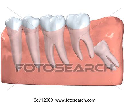 Stock Illustration - Low-level impacted third molar.. Fotosearch