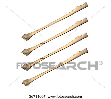 Oblique, spiral, and transverse hairline fractures. View Large Illustration Stock Illustration - Oblique, spiral, and transverse hairline fractures.. Fotosearch