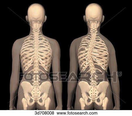 Scoliosis (right) vs. normal spinal column (left). View Large Illustration Stock Illustration - Scoliosis (right) vs. normal spinal column (left).. Fotosearch