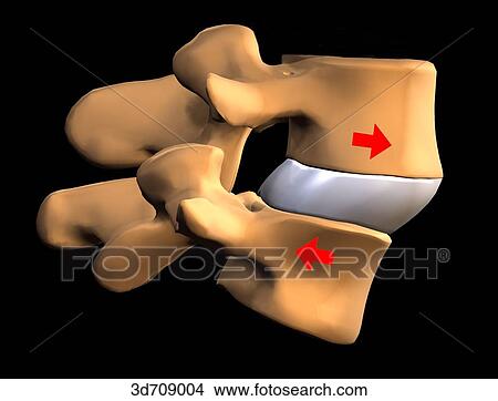 Spondylolisthesis is the forward slippage of lumbar vertebrae. View Large Illustration Stock Illustration - Spondylolisthesis is the forward slippage of lumbar vertebrae.. Fotosearch