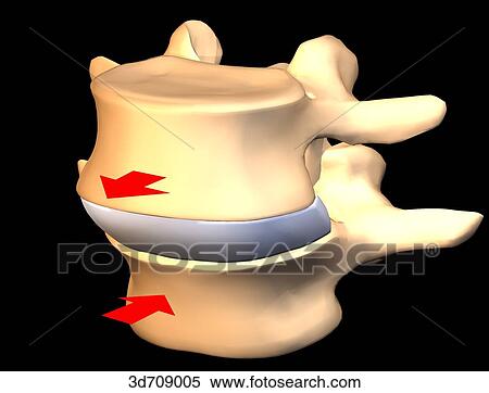 Stock Illustration - Spondylolisthesis is the forward slippage of lumbar vertebrae.. Fotosearch