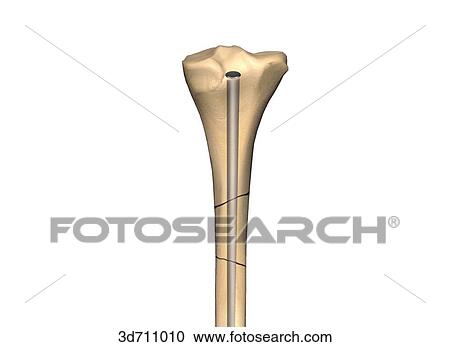 Clipart - Stabilization of a segmental fracture by direct fixation with a medullary nail.. Fotosearch