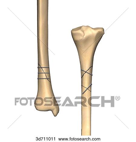Clip Art - Stabilization of oblique or spiral fractures by direct fixation with screws.. Fotosearch